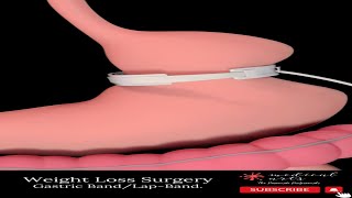 Weight Loss Surgery | Gastric Band | Lap-Band #Shorts