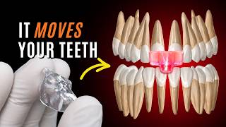 Why Your NTI Is Secretly Damaging Your Bite #nti #tmj #teethgrinding