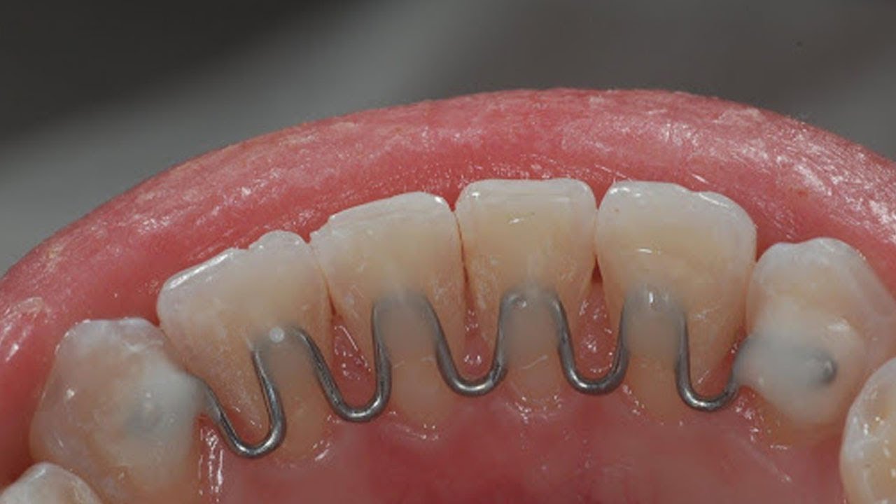 Voc Sabe Para Que Serve A Conten o Fixa Dentes E Aparelho Dent rio voc-sabe-para-que-serve-a-conten-o-fixa-dentes-e-aparelho-dent-rio