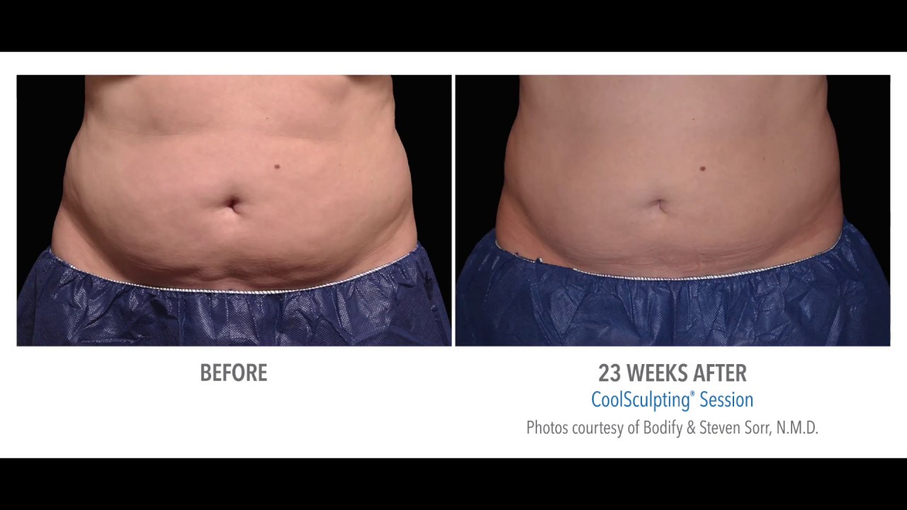 Coolsculpting Before & After YouTube