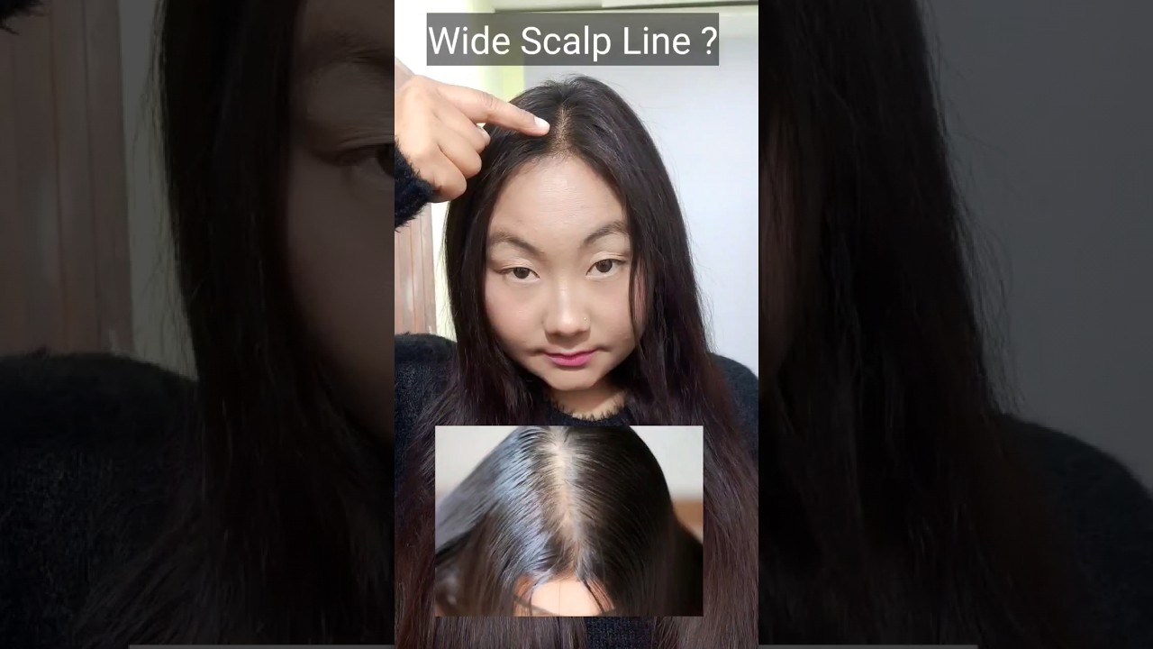 Do you have Wide Scalp Line? Then Try This 👍 
