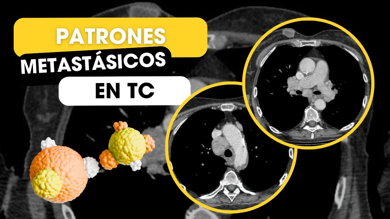 Patrones metastásicos que debes conocer YA