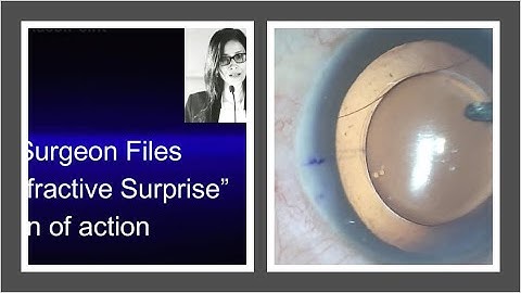 The Toric Tale - planning and executing toric repositioning - The Surgeon Files