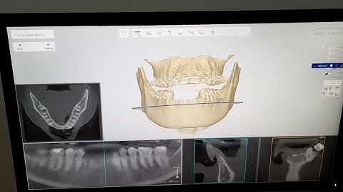 Implant Studio 3Shape