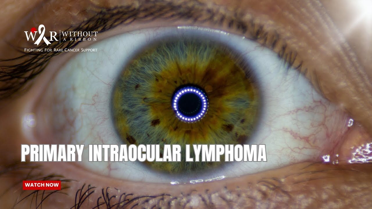 Primary Intraocular Lymphoma