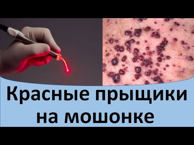 Красные прыщики на мошонке
