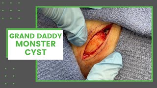 Grand Daddy Monster Cyst | Dr. Derm