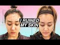 MY SKIN STORY: How I Ruined My Skin (And Fixed It)