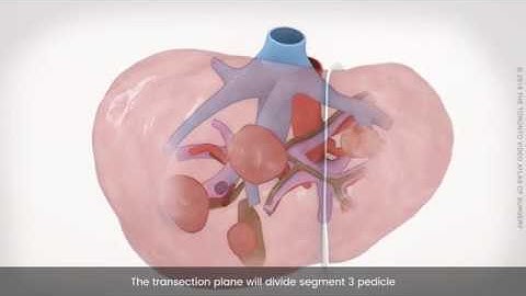 Laparoscopic left lateral sectionectomy