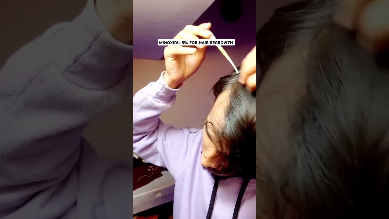 FORMEN HAIR ESSENTIALS ⚡ Minoxidil 5% for hair regrowth