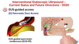 Interventional Endoscopic Ultrasound Current Status And Future Directions. Aga White Paper.