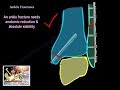 Ankle Fractures - Everything You Need To Know - Dr. Nabil Ebraheim