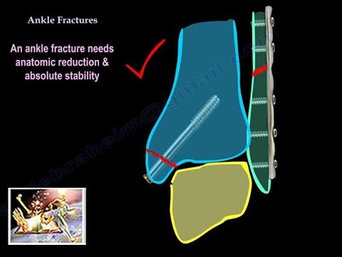 Ankle Fractures - Everything You Need To Know - Dr. Nabil Ebraheim