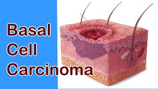 Basal Cell Carcinoma: Not the Most Deadly, but is Certainly the Most Destructive Form of Skin Cancer