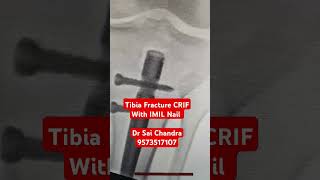 Tibia Fracture CRIF With IMIL Nail ..Dr Sai Chandra..9573517107