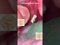 Tonsil stone removal at home