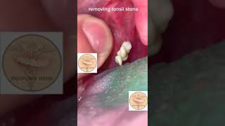 Tonsil Stone REMOVAL AT HOME