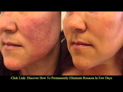  symptoms of rosacea | Rosacea natural treatment