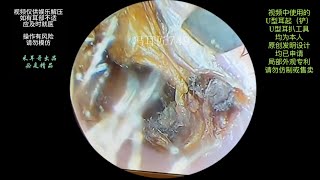 采耳哥-Cleaning of dried fungal specimens from the ear canal and eardrum ｜749