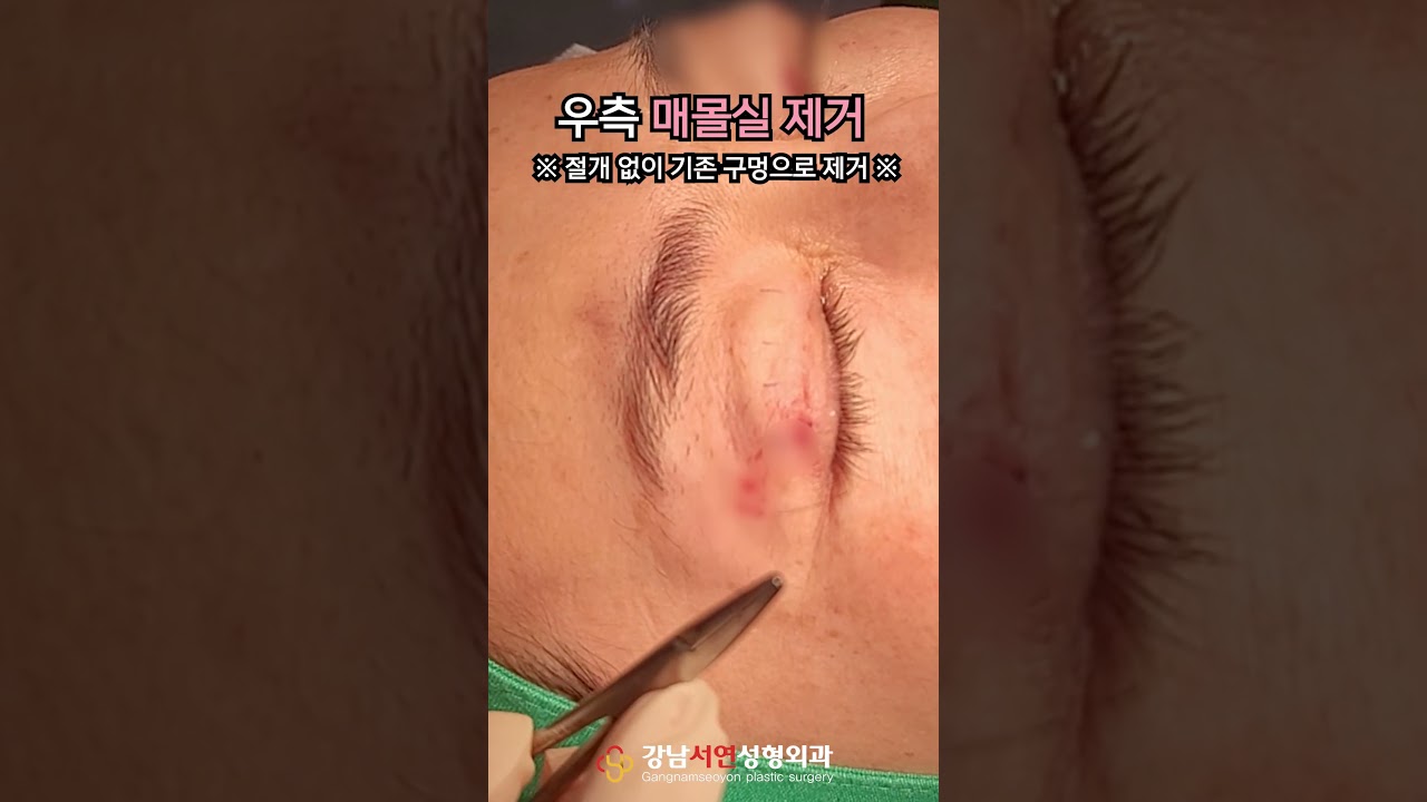 [Ганнам Соён гоо сайхны мэс заслын эмнэлэг] 🌟 Ганнам Соён Суулгасан утсыг зайлуулах🌟 - Харааны ASMR