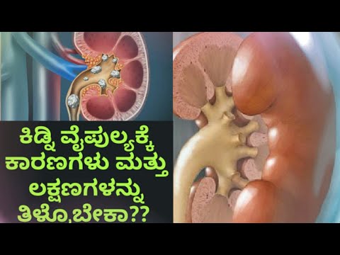 ಕಿಡ್ನಿ ವೈಫಲ್ಯಕ್ಕೆ ಕಾರಣಗಳು ಮತ್ತು ಲಕ್ಷಣಗಳು || symptoms and causes of kidney disease ||