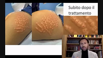 Come eliminare le smagliature bianche definitivamente?