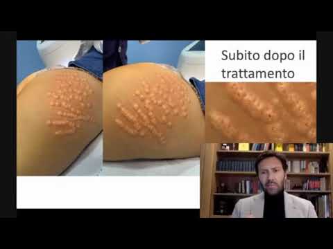 Video: Gambe Pelose, Cicatrici, Acne, Smagliature E Altre Imperfezioni Nell'aspetto Delle Stelle: Foto