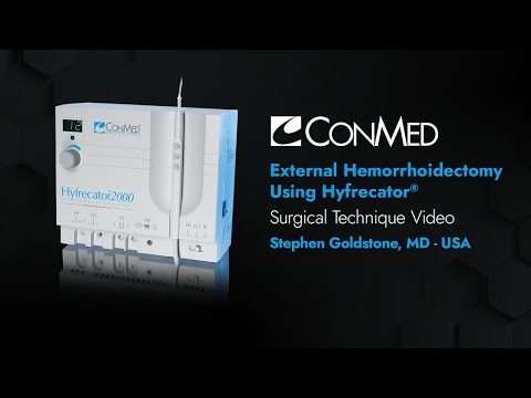 Dr. Stephen Goldstone - External Hemorrhoidectomy Using Hyfrecator® - CONMED Surgical Technique