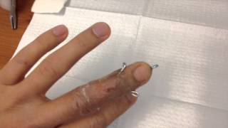 Broken finger pin removal