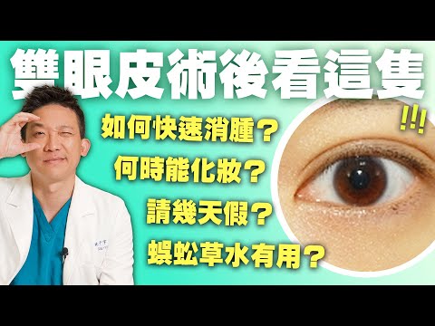 縫雙眼皮能全身麻醉？幾天戴隱形眼鏡？ 割雙眼皮要拆線嗎？一次解答所有疑惑！｜新聖整形外科 林子宇醫師