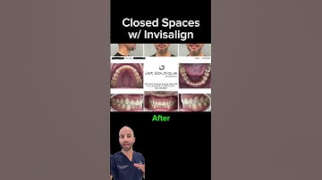 Adult Invisalign to Close Spaces/Gaps Between the Teeth