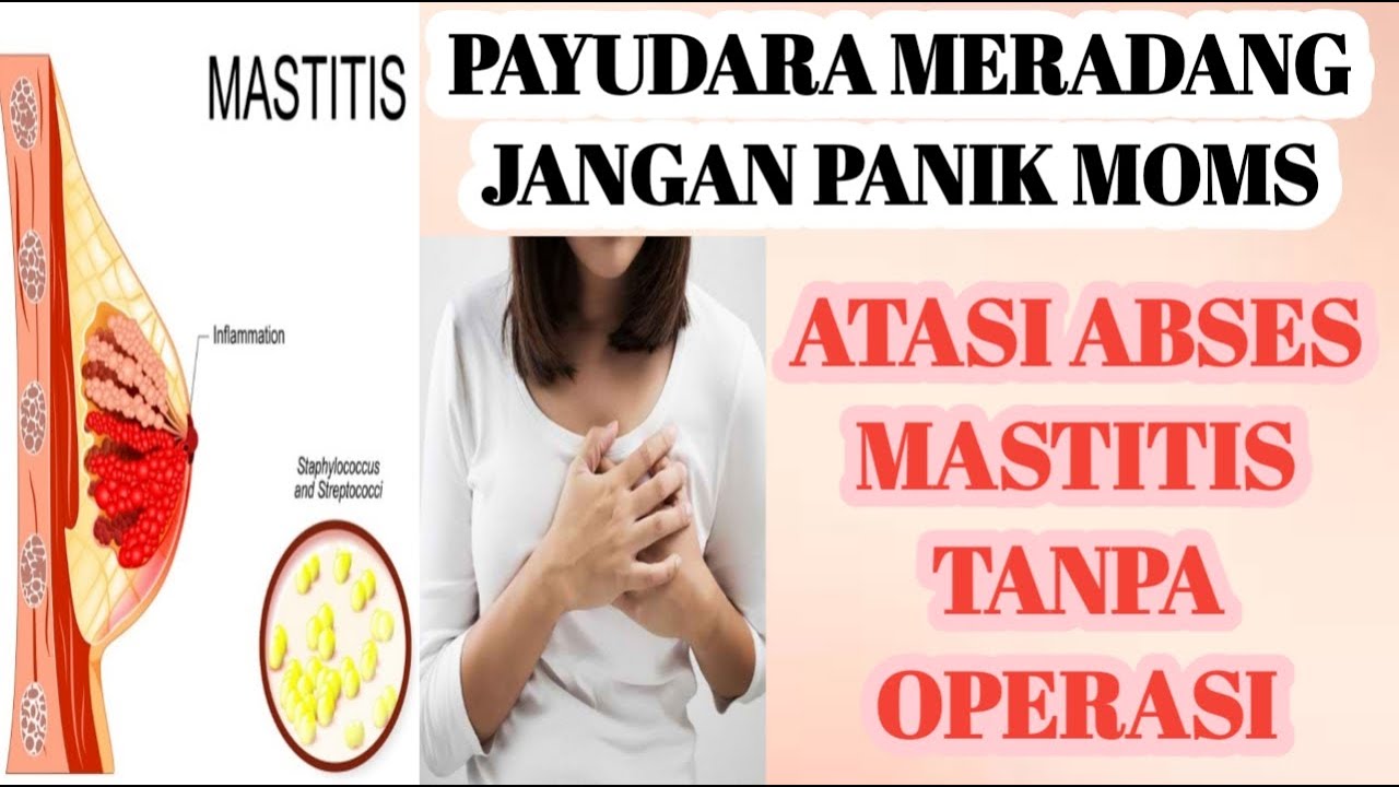 PENGALAMAN ABSES PAYUDARA | Atasi MASTITIS tanpa OPERASI | CARA MUDAH