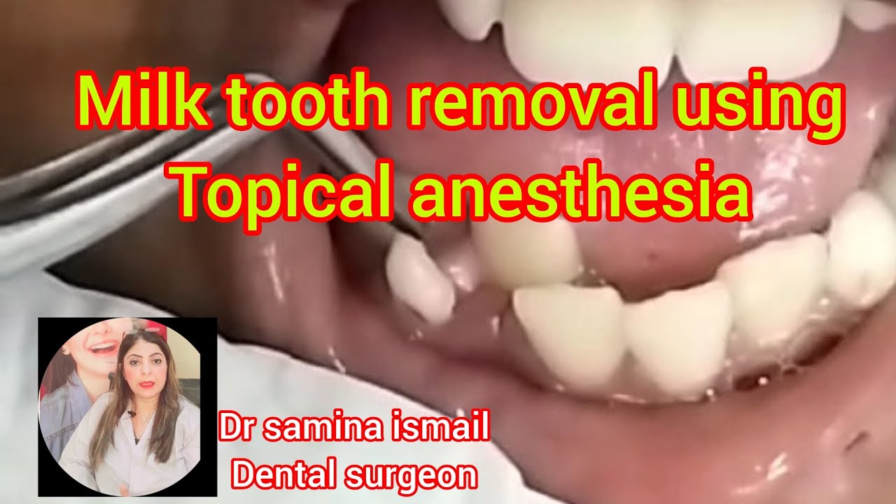 baby-tooth-removal-tooth-extractions-baby-tooth-extraction-youtube