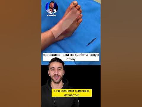 пересадка кожи - YouTube