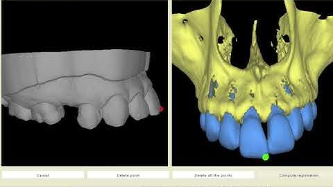 AxisGuide®: Overlay of STL file on CBCT