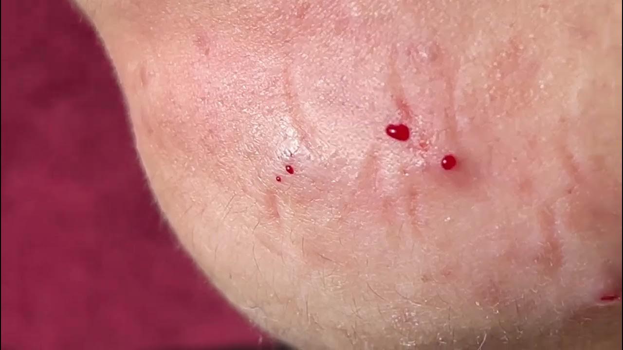 ACNE TREATMENT MAI NGOC - YouTube