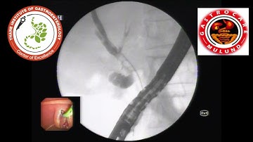 ERCP + BILIARY SPHINCTEROTOMY + CBD STONE EXTRACTION + STENTING