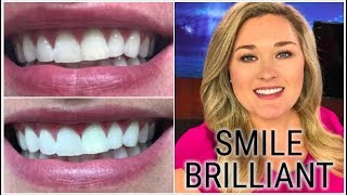 Professional Teeth Whitening At Home Smile Brilliant Taren Denise