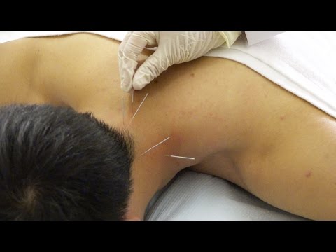 Videó: Le kell vetkőzni az akupunktúrához?