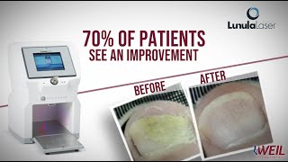 Weil Foot Ankle Has Lunula Laser Treatment