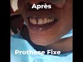 Prothse fixe clinique dentaire dabia