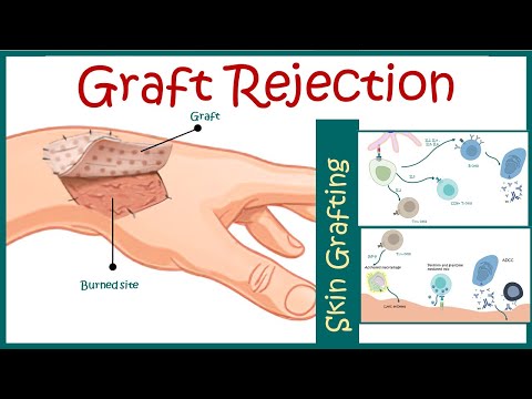 Graft rejection || Immunological basis of graft rejection