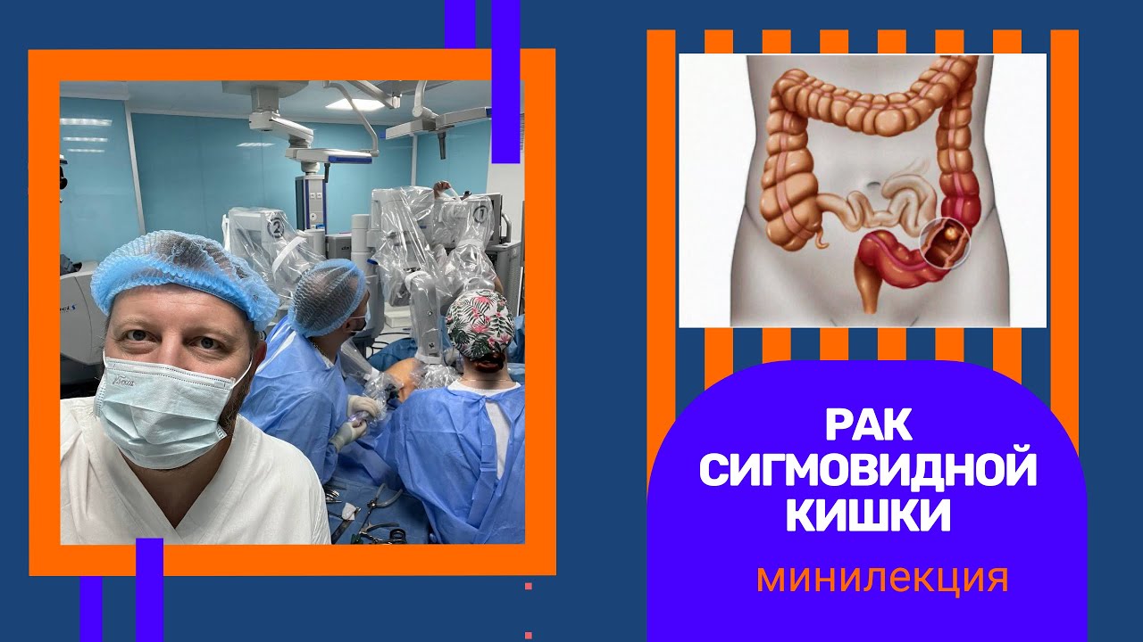 Рак сигмовидной кишки l Дмитрий Савенков l Онкохирург l Днепр - YouTube