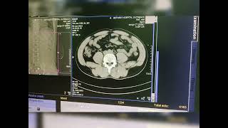Siemens Somatom Spirit Dual Slice CT Scanner