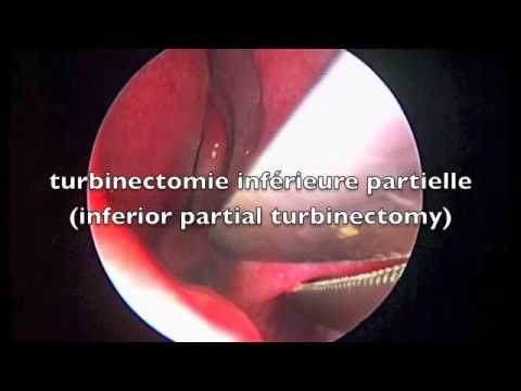 Video: Turbinectomie: Procedure En Follow-up