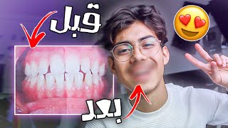 تجربتي مع تقويم الاسنان بعد 3 سنين!! ( النتيجة بتصدمكم ) 