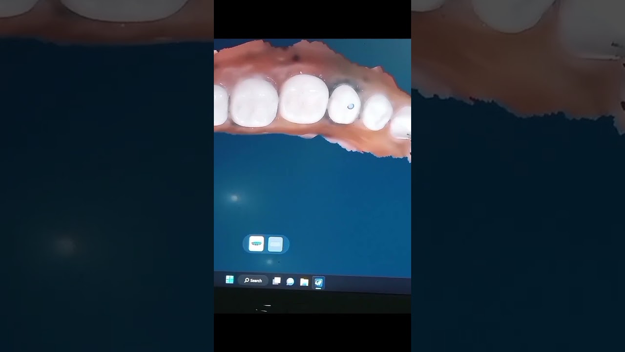 TIPS DIGITAL IMPRESSION MENGGUNAKAN HELIOS 600 INTRAORAL SCANER