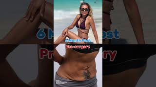 6 Months Post Tummy Tuck #plasticsurgery #plasticsurgeon #beforeandafter #tummytuck