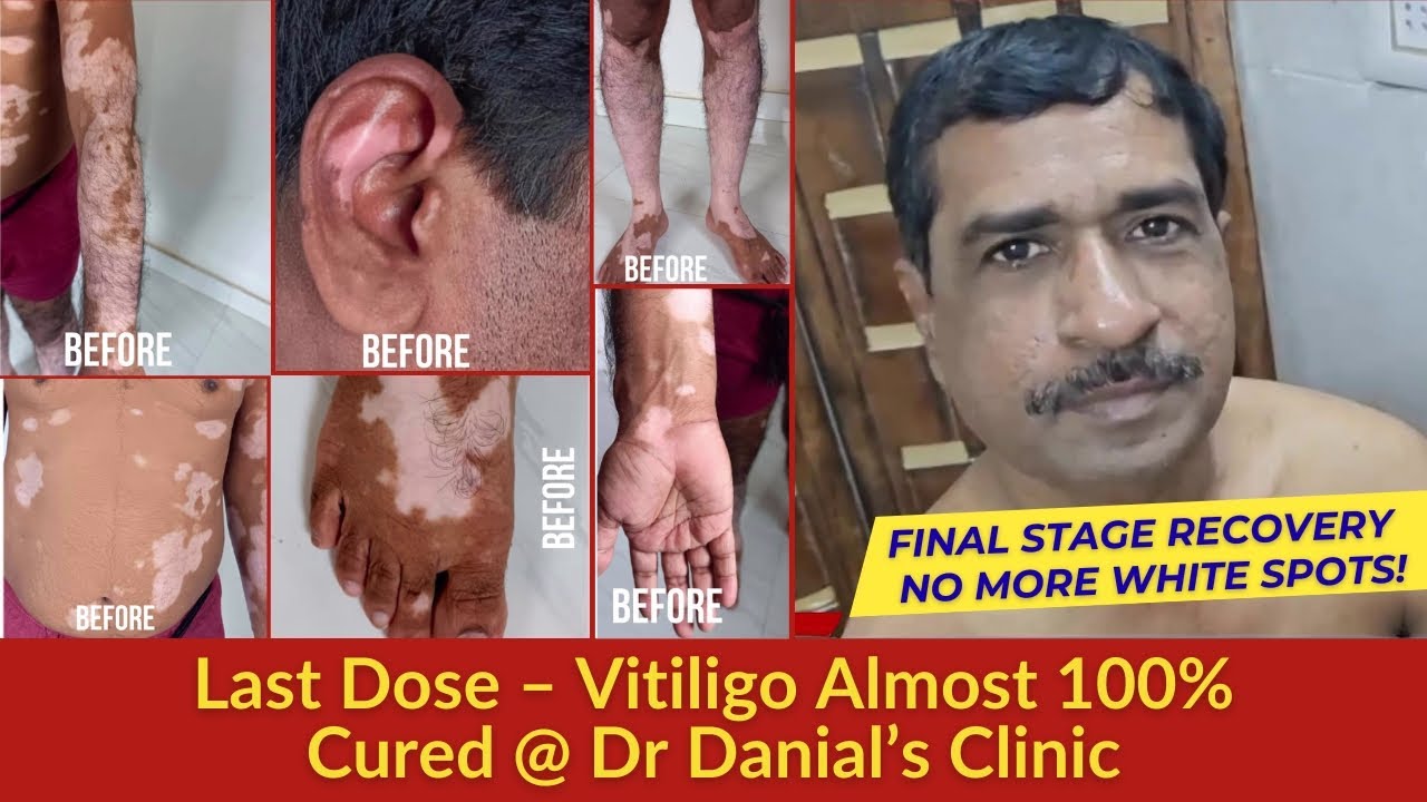 Final Stage Recovery  No More White Spots! | Last Dose – Vitiligo Almost 100% Cured @ Dr Danial’s