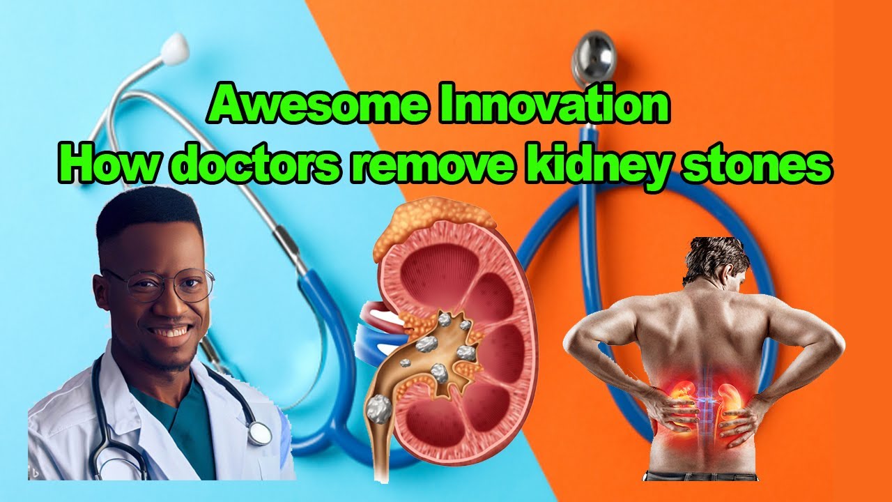 How Doctors Remove Kidney Stones YouTube How doctors remove kidney stones youtube